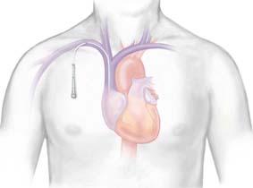 Central Venous Catheter